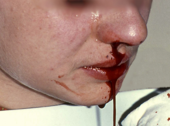 Sangue dal naso: come comportarsi? Per imparare a gestirlo senza timori