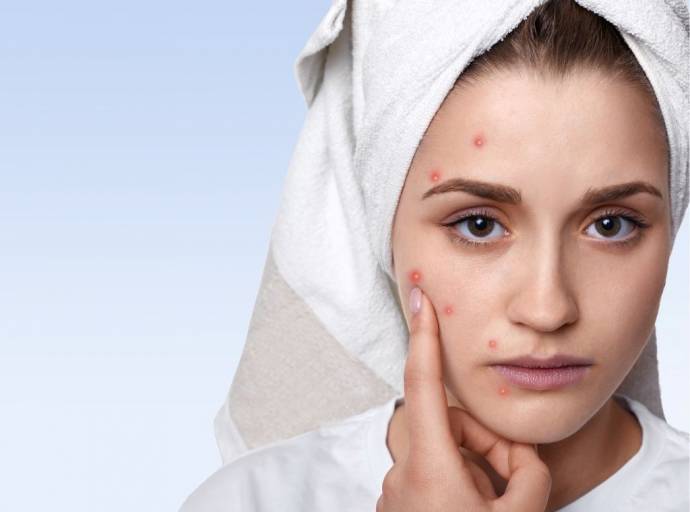 Sette regole d'oro per combattere l'acne nei cambi di stagione: soprattutto autunno e primavera