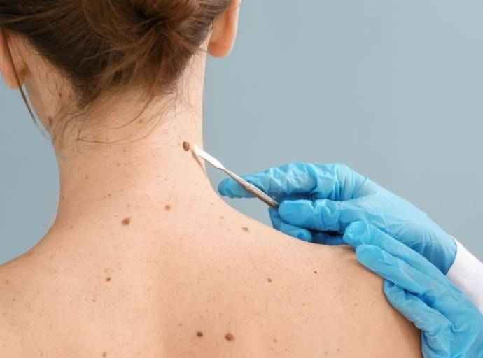 Abbinato all'immunoterapia, il vaccino a mRna contro il melanoma, dimezza il rischio di recidiva del tumore