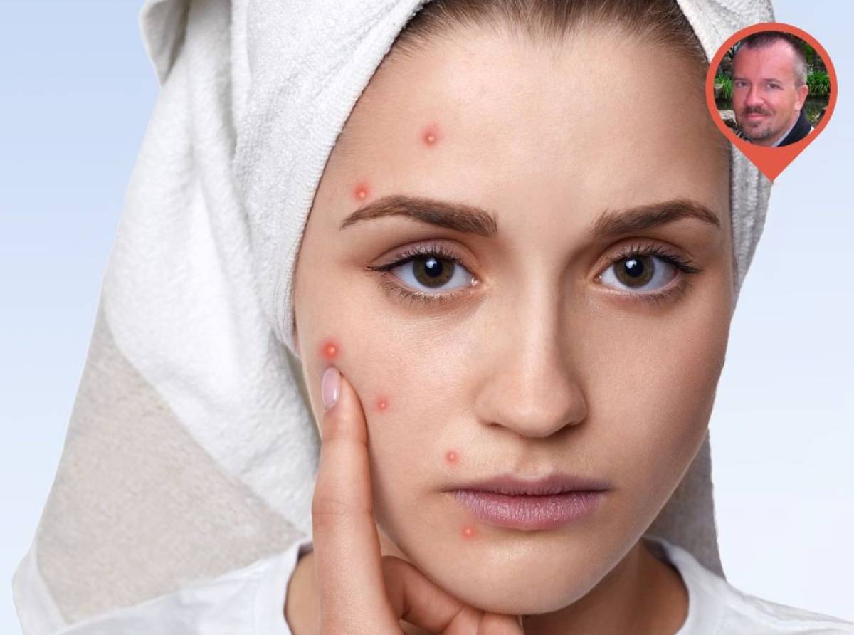 Sette regole d'oro per combattere l'acne nei cambi di stagione: soprattutto autunno e primavera