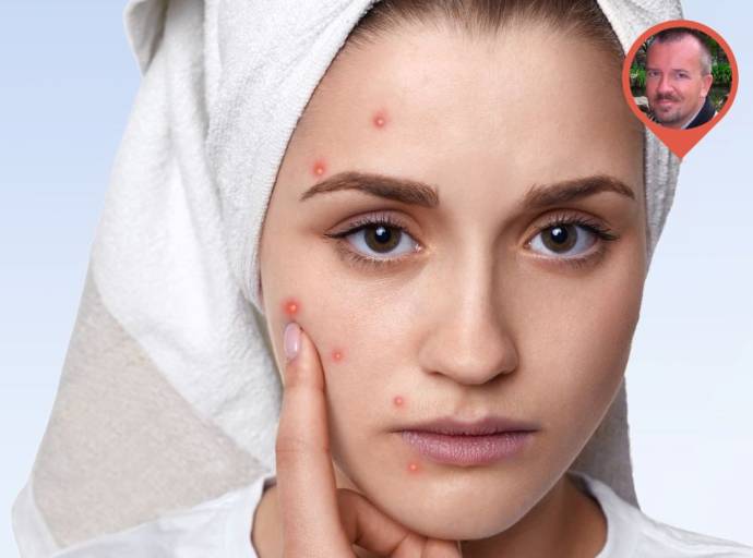 Sette regole d'oro per combattere l'acne nei cambi di stagione: soprattutto autunno e primavera