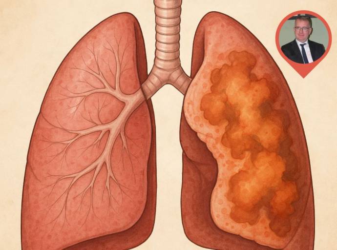 Polmonite: come riconoscere l’infezione e prevenirne le complicanze attraverso diagnosi tempestiva e vaccinazioni